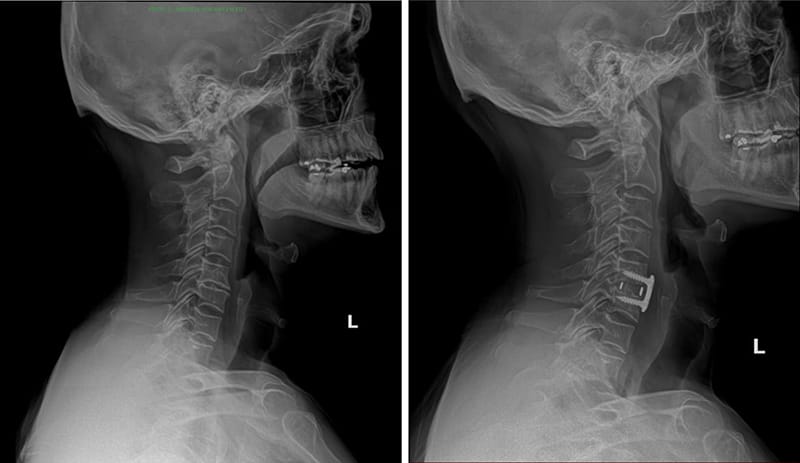 discectomy before and after