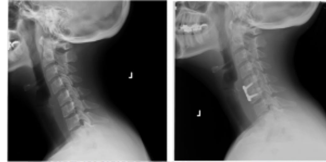 discectomy before and after