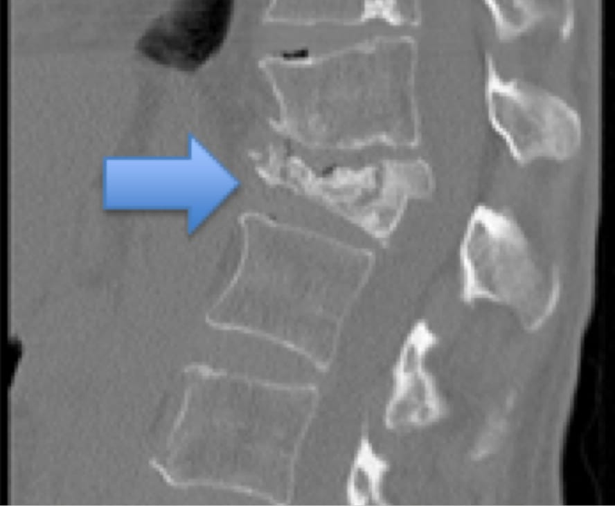 compression fracture of lumbar spine